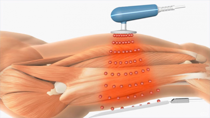 θεραπεία με ραδιοσυχνότητες TECAR