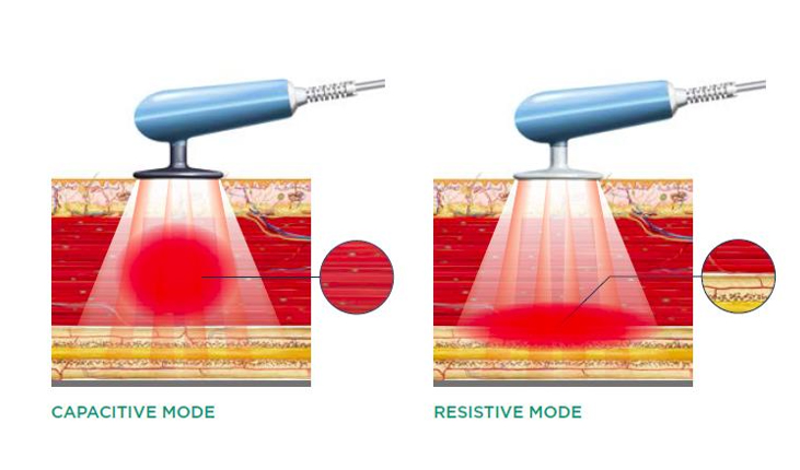 θεραπεία με ραδιοσυχνότητες TECAR